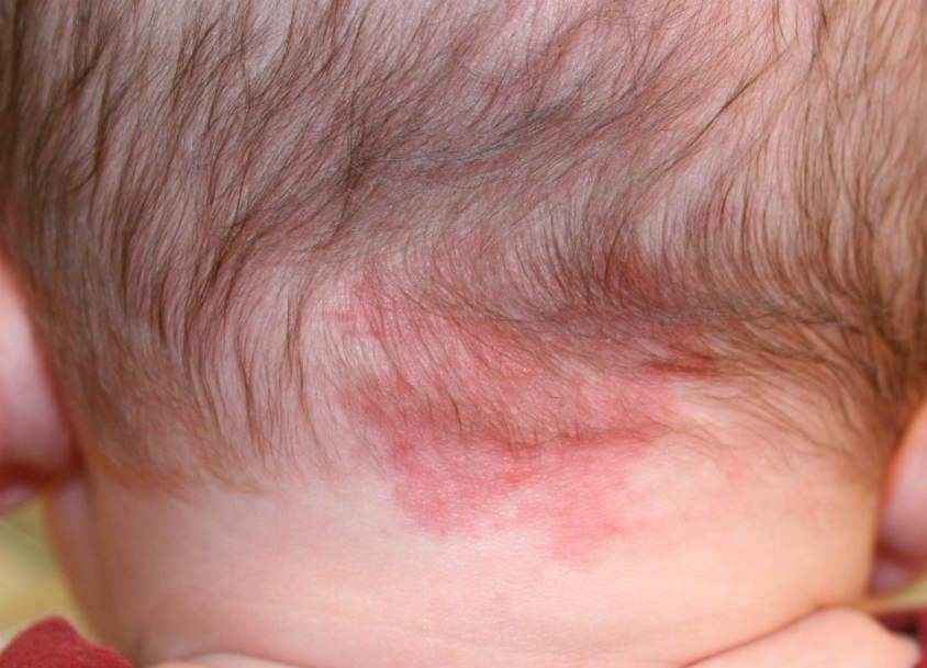 المرحلة الثانية: طفح المواليد الطبيعي - البقعة البتظهر مع البكاء Salmon patch / Nevus simplex (7/7)