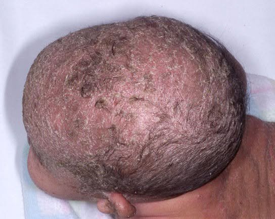 المرحلة الثالثة: مشاكل الرضّع الشائعة - قبعة المهد: البسيطة والمقنّعة Infantile seborrheic dermatitis (5/6)