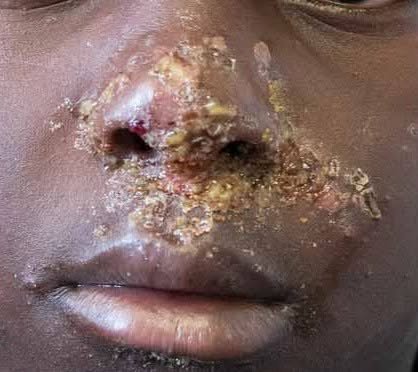 المرحلة الرابعة: الطفولة المبكرة (٣ من ١٠) - القوباء، من قشور العسل لمشاكل الكلى (Impetigo)
