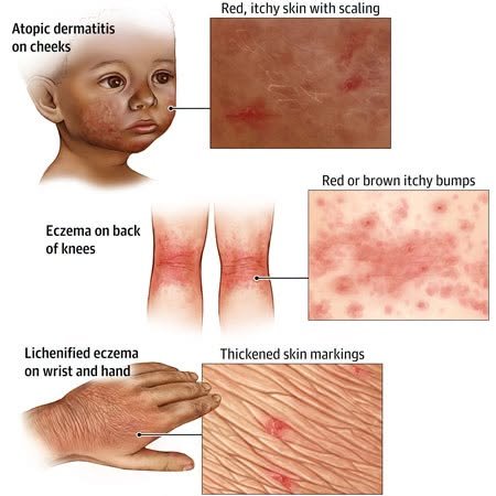 المرحلة الرابعة: الطفولة المبكرة (٥ من ١٠) - الأكزيما بعيون سودانية (Atopic dermatitis) - الجزء الأول: الصورة السريرية المختلفة