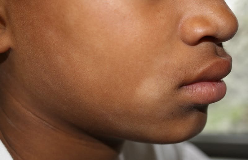 المرحلة الرابعة: الطفولة المبكرة (٧ من ١٠) - البقع البيضة على الوش: غالباً ما بهاق (Pityriasis alba)