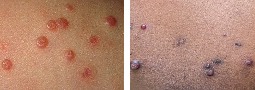 المرحلة الرابعة: الطفولة المبكرة - الحبوب ذات النقرة: نعالجها متين ونخليها متين؟ (Molluscum contagiosum) (١٠/١٠)