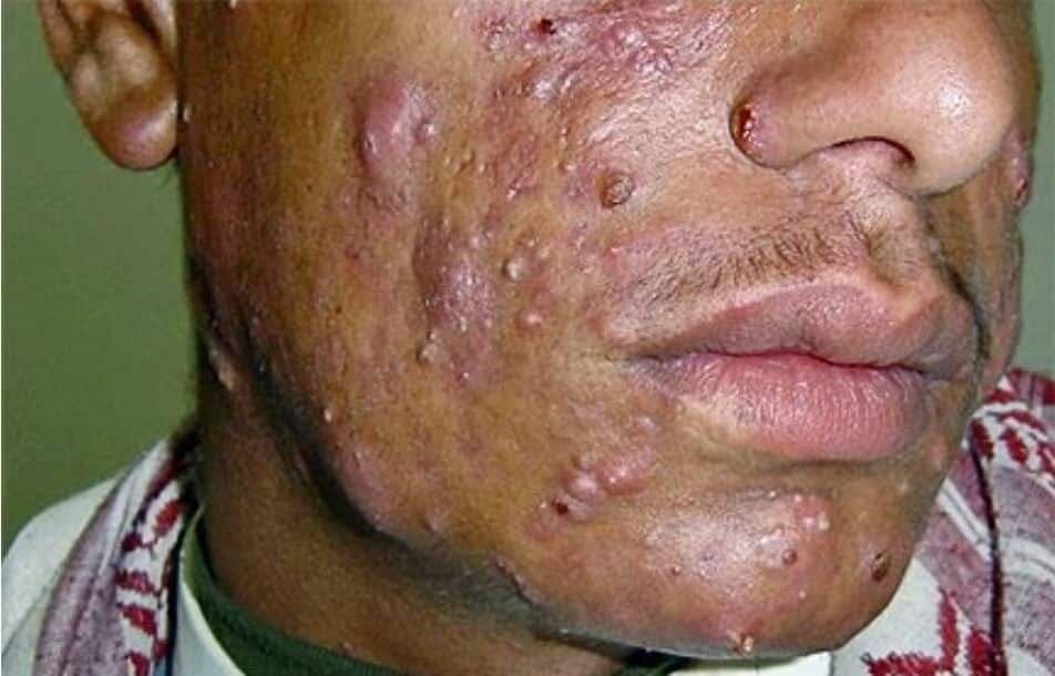 العلاج بالايسوتريتنوين (روكيوتان/اكنوتين)