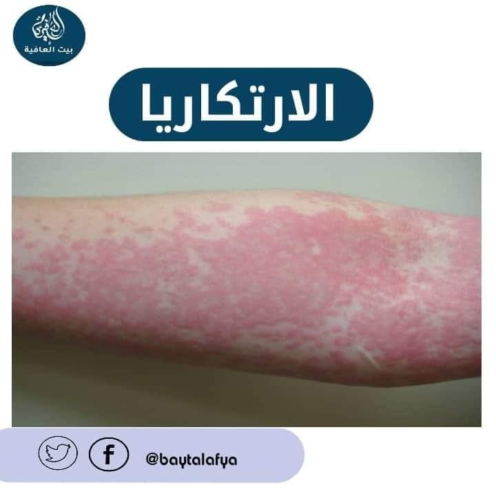 أعراض نادرة قد تصاحب الارتكاريا Urticaria
