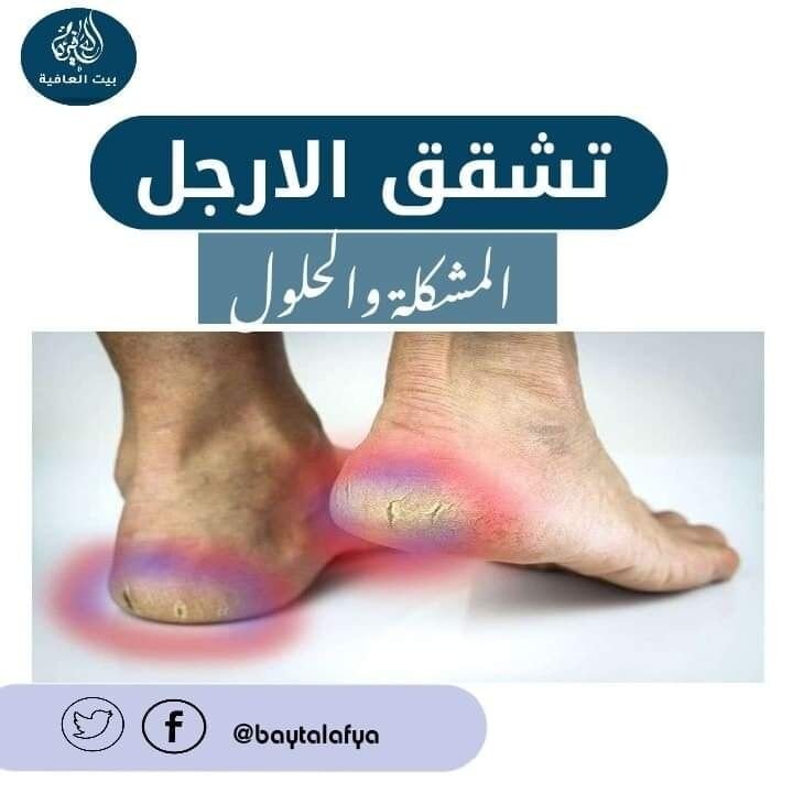 تشقق الأرجل: المشكلة والحلول