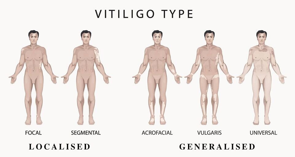 البُهَاق (Vitiligo) هو مرض جلدي مزمن يتميز بفقدان الصباغ في مناطق معينة من