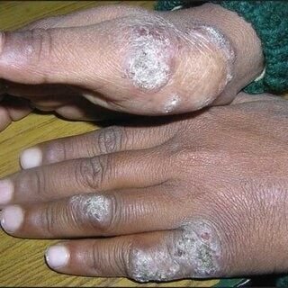 عن الثؤلول السلي tuberculosis verrucosa cutis
