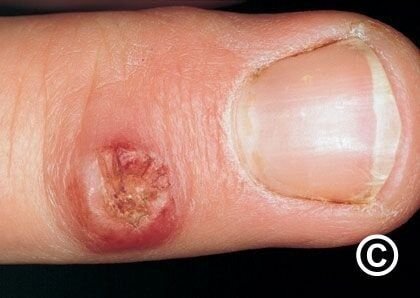 عقيدات الحلابين Milker's nodules