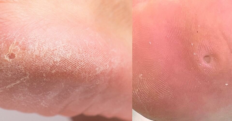🌟 تقرن القدمين ومسامير القدم Corns & Callous 🌟