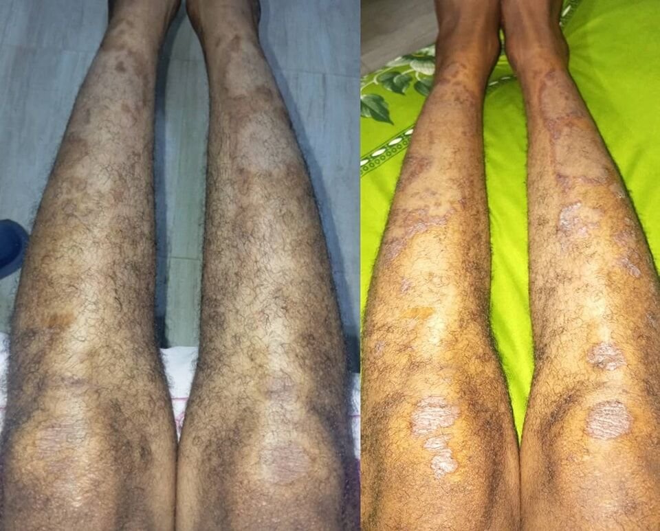 الصدفية Psoriasis من أكثر الأمراض الجلدية شيوعا