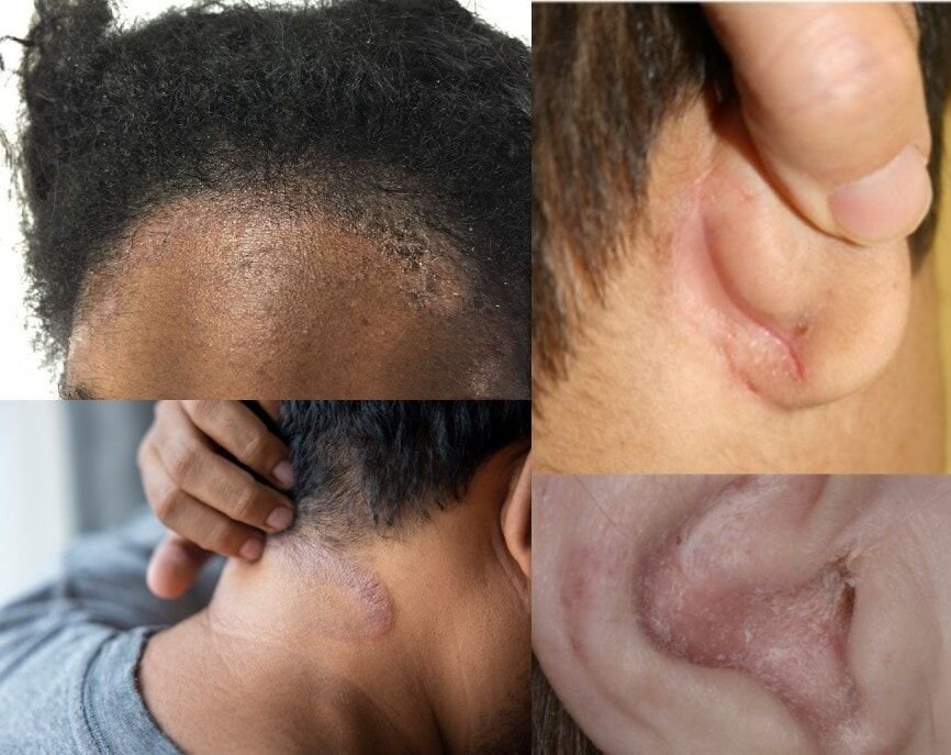 ما هي الصدفية الزهمية Sebo Psoriasis ؟
