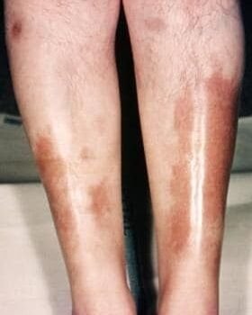 نخر البشرة الشحمي Necrobiosis Lipodica
