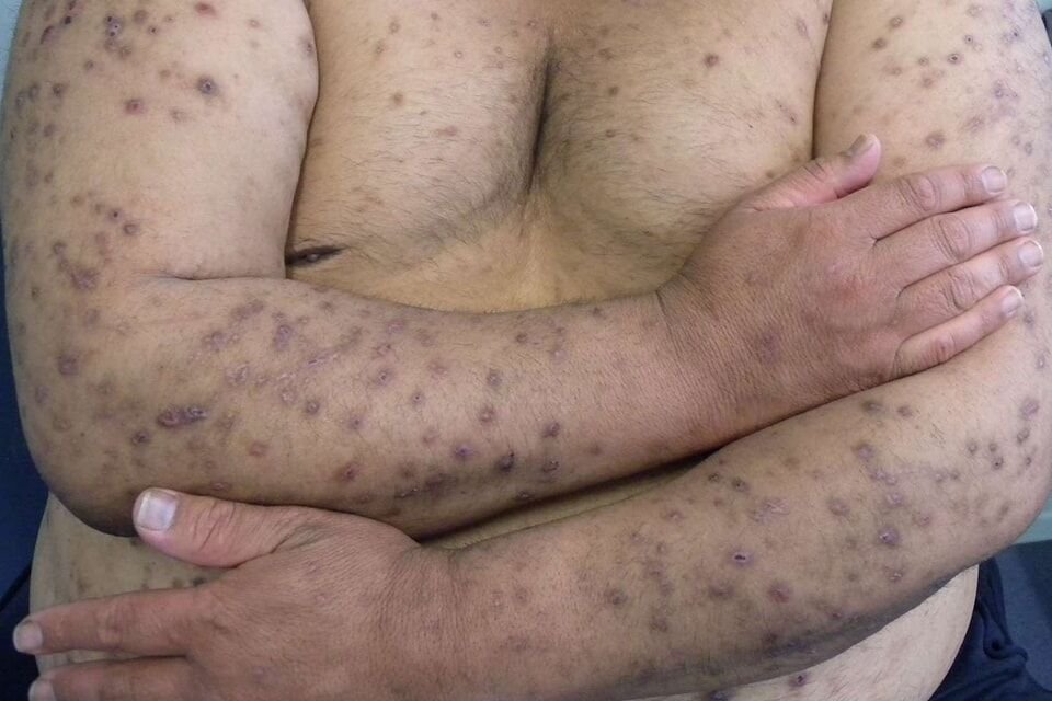 🎯 البثور الحاكة (Prurigo) - المرض الأشد إزعاجا!
