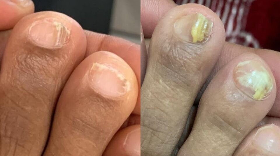 ‎👣 فطريات الأظافر (Onychomycosis)