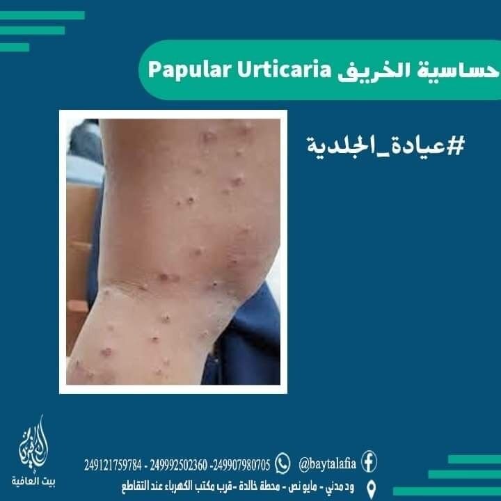 حساسية الخريف Papular Urticaria