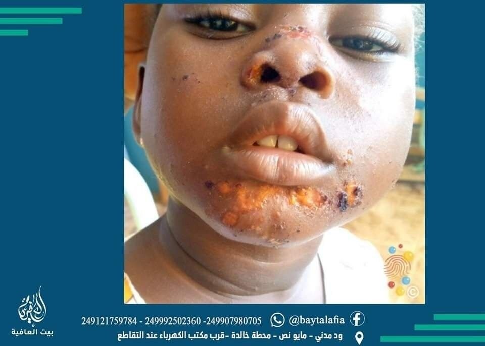 الحصف البكتيري Impetigo