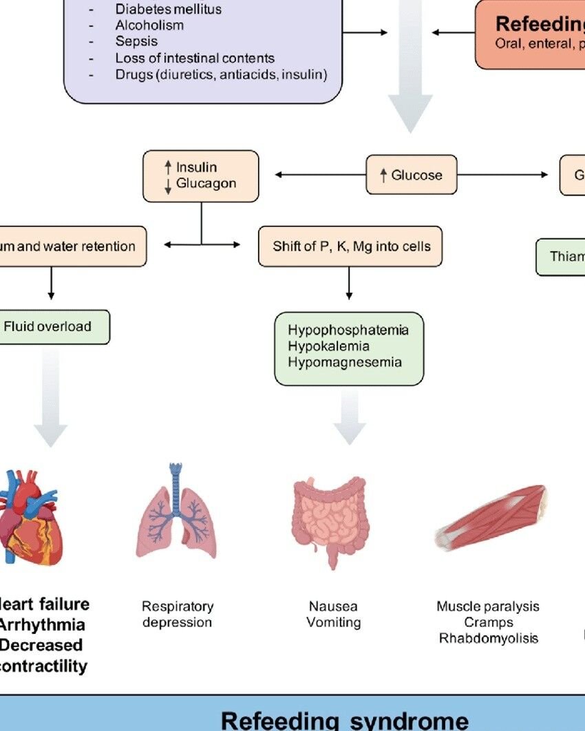 متلازمة إعادة التغذية (Refeeding Syndrome)