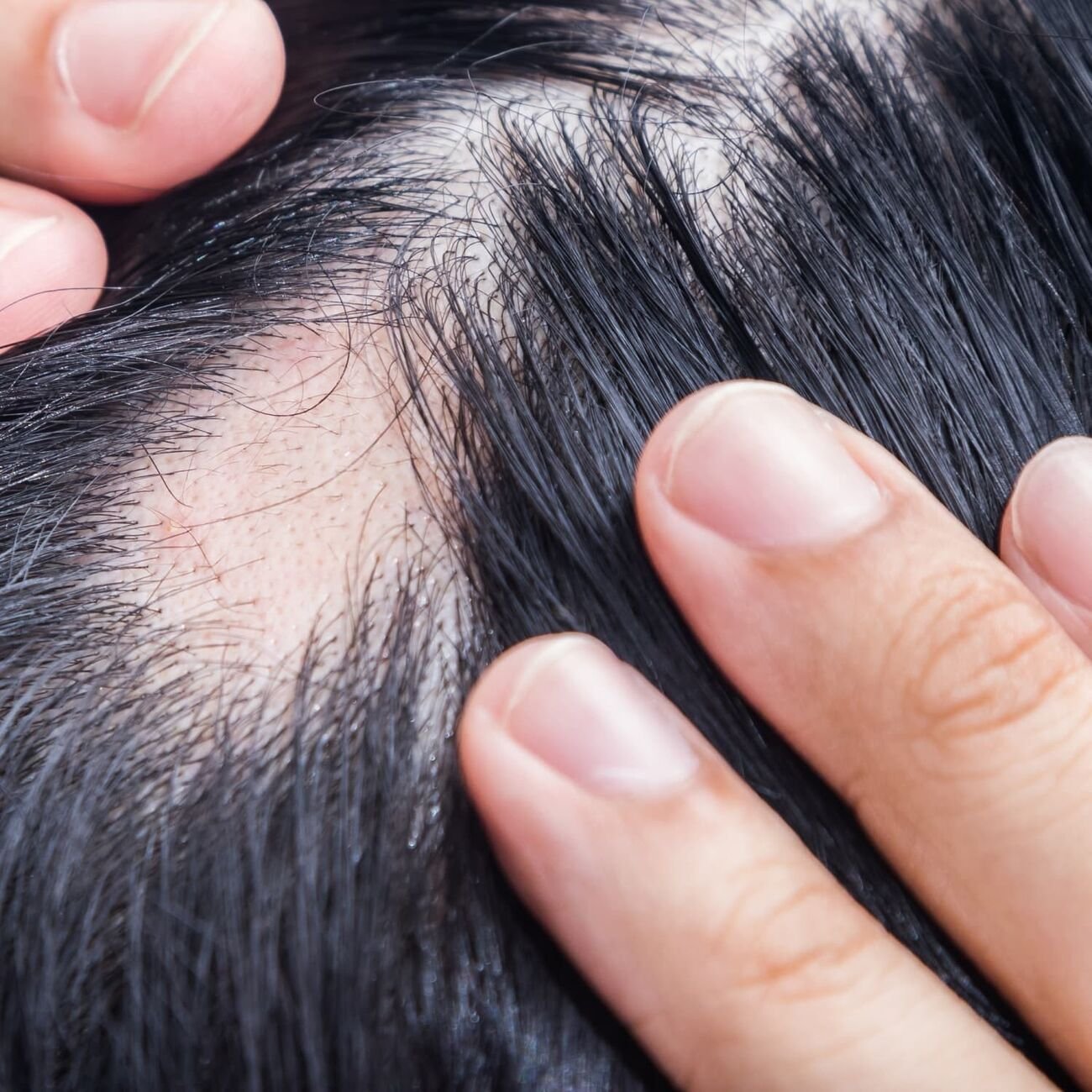 الثعلبة البقعية (Alopecia Areata)
