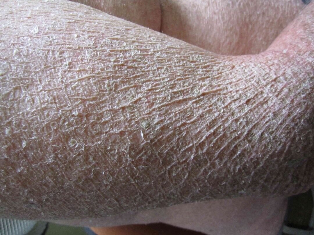 السماك الشائع (Ichthyosis Vulgaris):