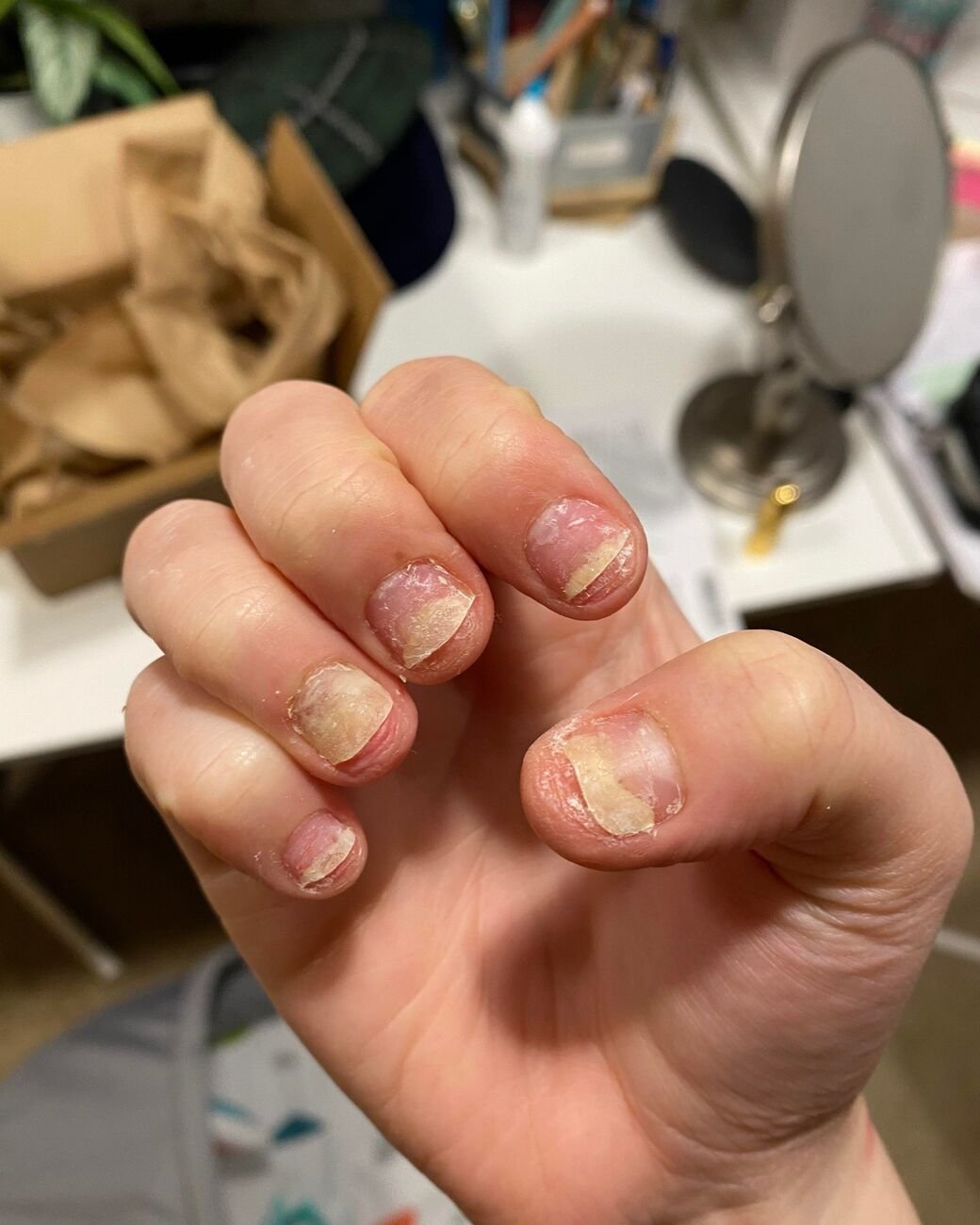 انفصال الأظافر (Onycholysis)