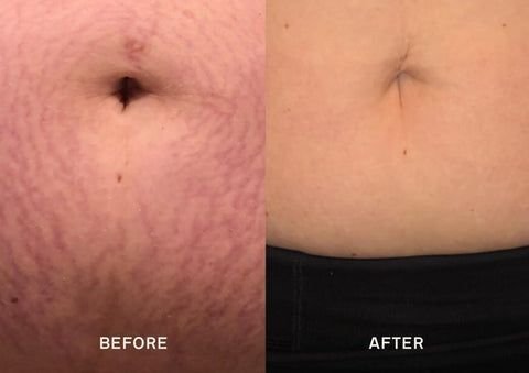 المستحضرات ذاتية التسمير: حيلة لإخفاء علامات التمدد 🌞✨