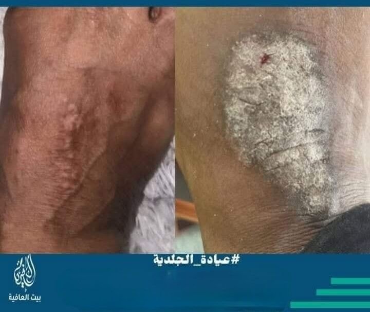 الحزاز البسيط المزمن Lichen Simplex Chronicus
