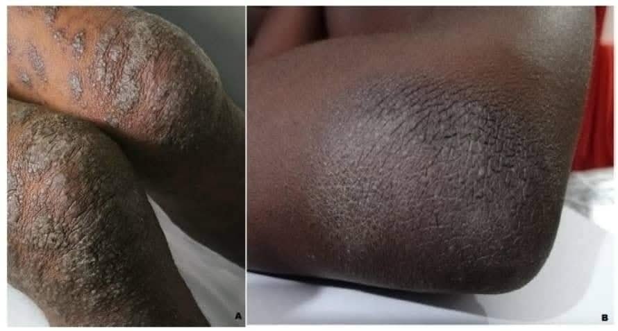 التهاب الجلد التحسسي (Atopic Dermatitis)