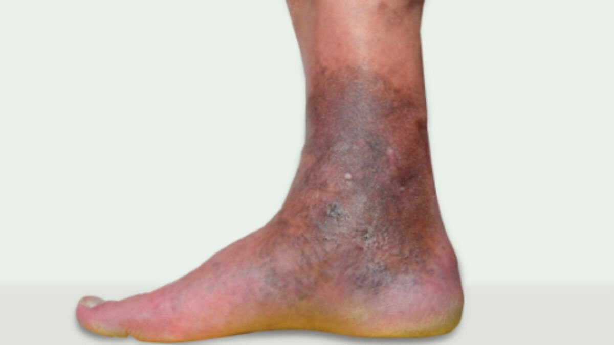 القصور الوريدي المزمن (Chronic Venous Insufficiency) — الجزء 2