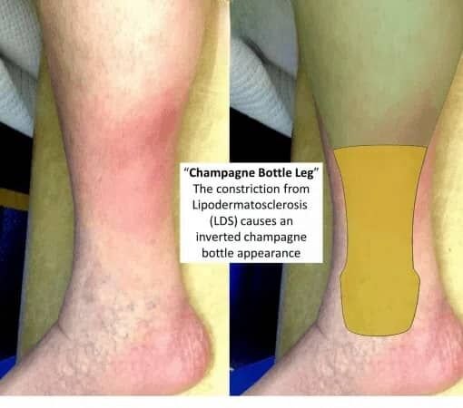 القصور الوريدي المزمن (Chronic Venous Insufficiency) — الجزء 3