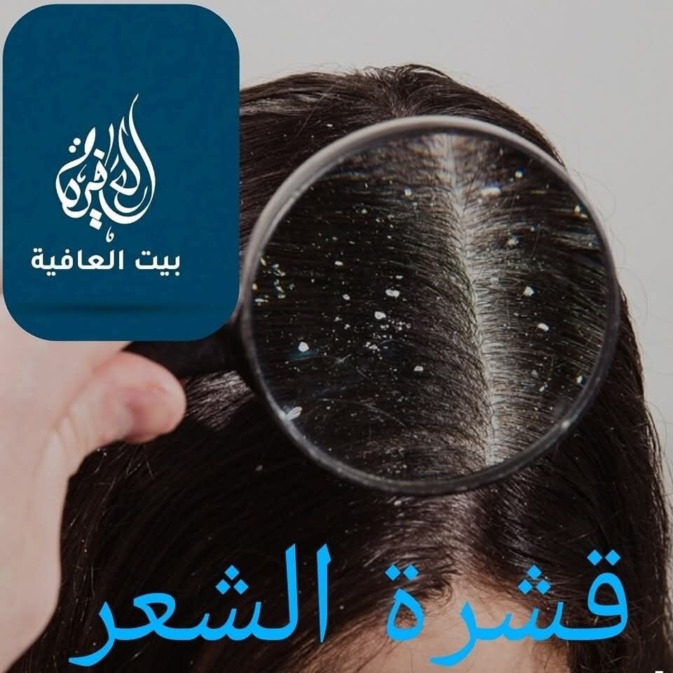 قشرة الرأس Dandruff :