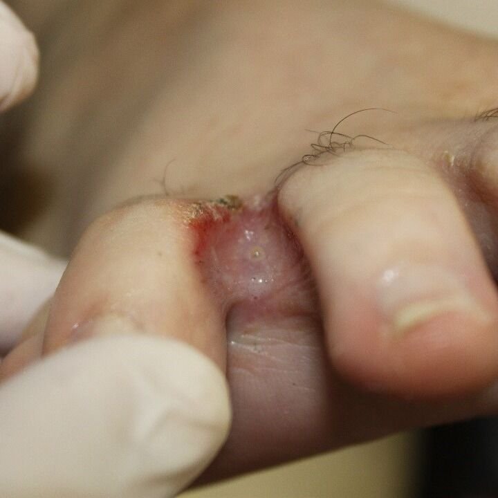 الإريثرازما — الصورة السريرية