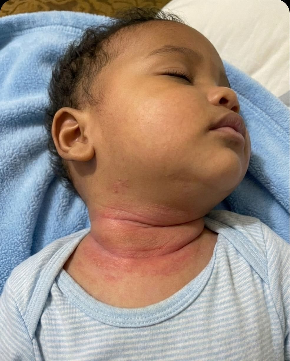 هل طفلك يعاني من احمرار مزعج بالرقبة؟