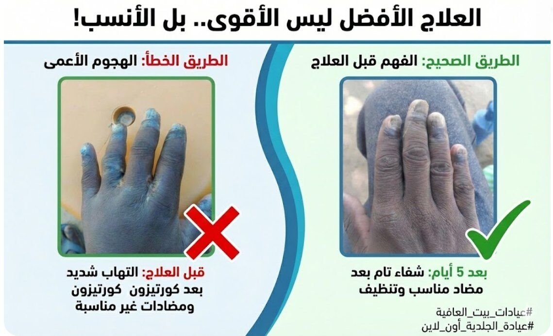 شنو هو العلاج الأفضل؟ مثال جديد