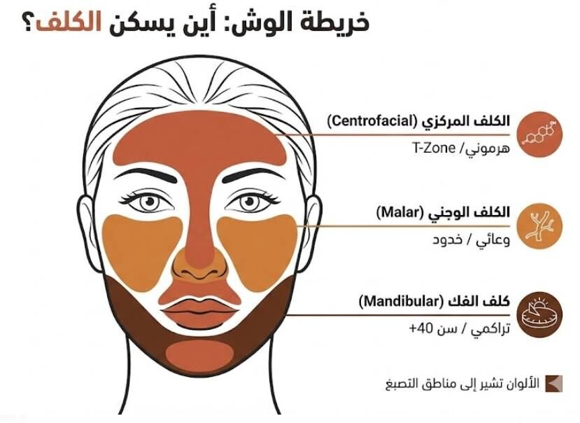 وماذا عن الكلف؟! (3)
