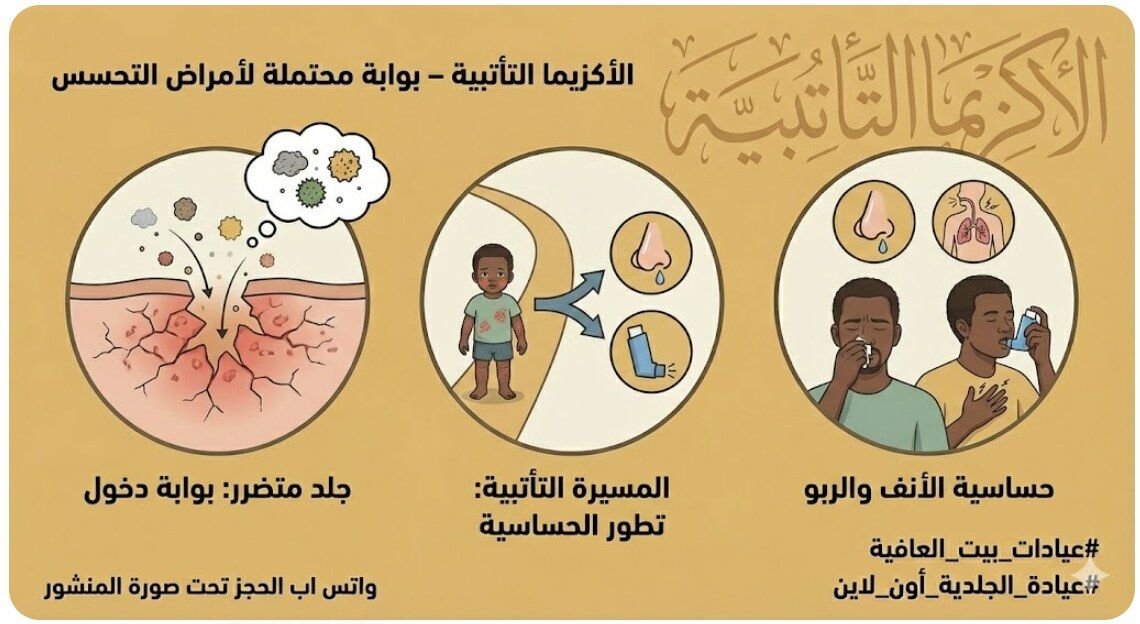 الاكزيما التأتبية – بوابة محتملة لأمراض التحسس
