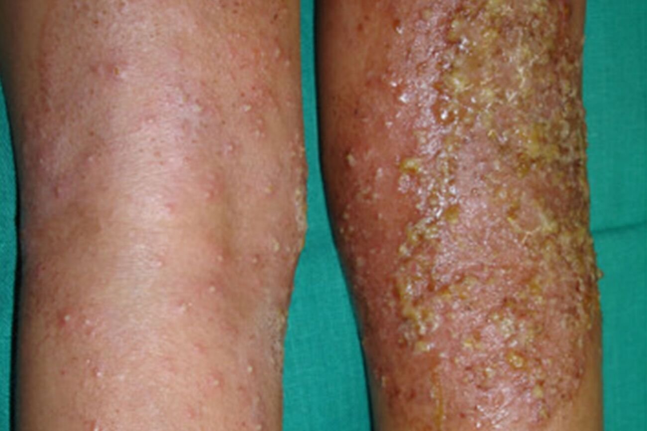 الاكزيما الانتانية infected Eczema