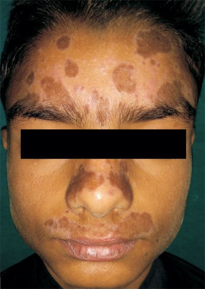 الحزاز الشمسي (Actinic LP)