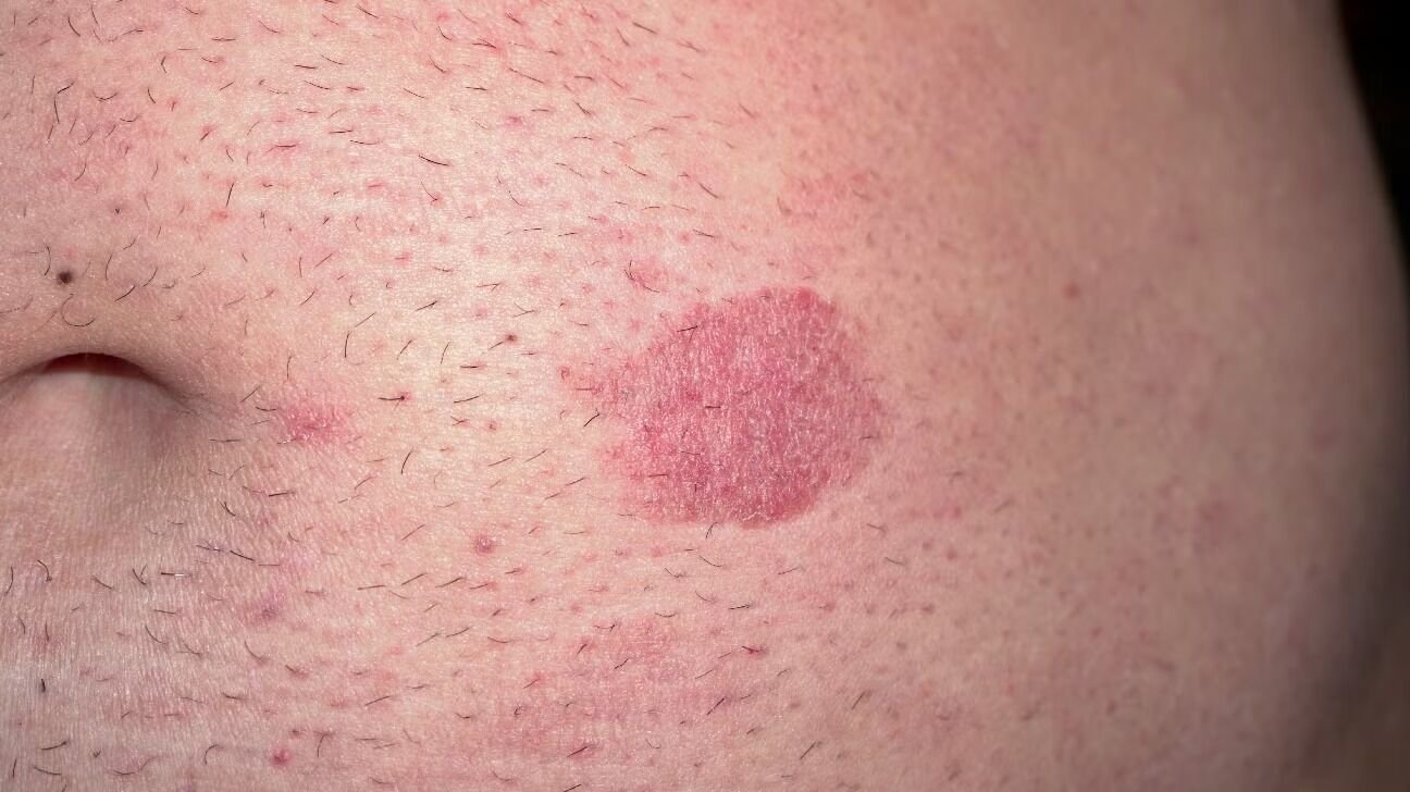 الفطر الفطراني (Mycosis Fungoides)