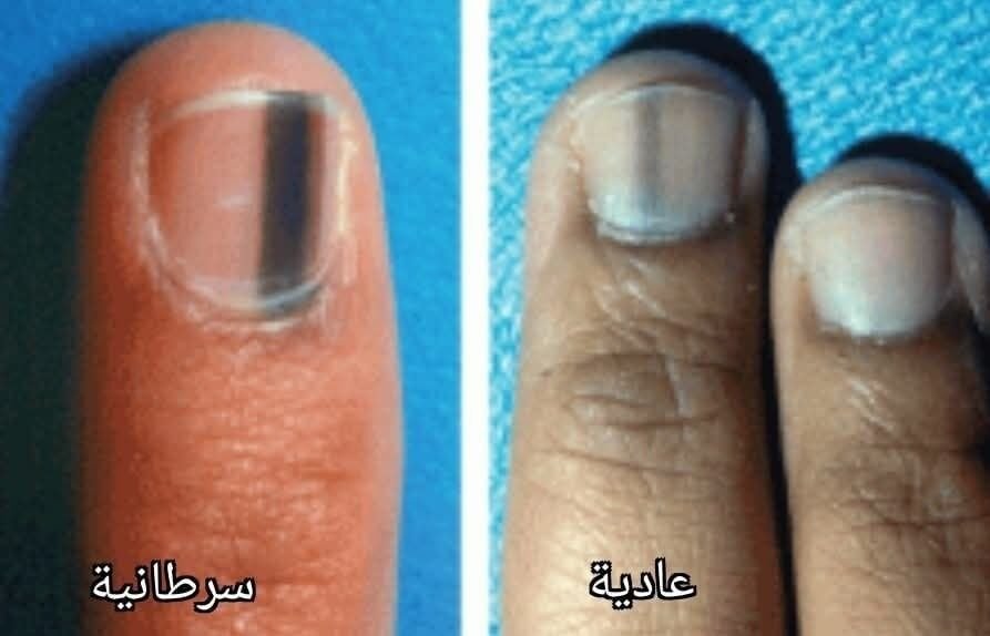 الفرق بين البقع الصباغية تحت الأظافر وسرطان الأظافر: