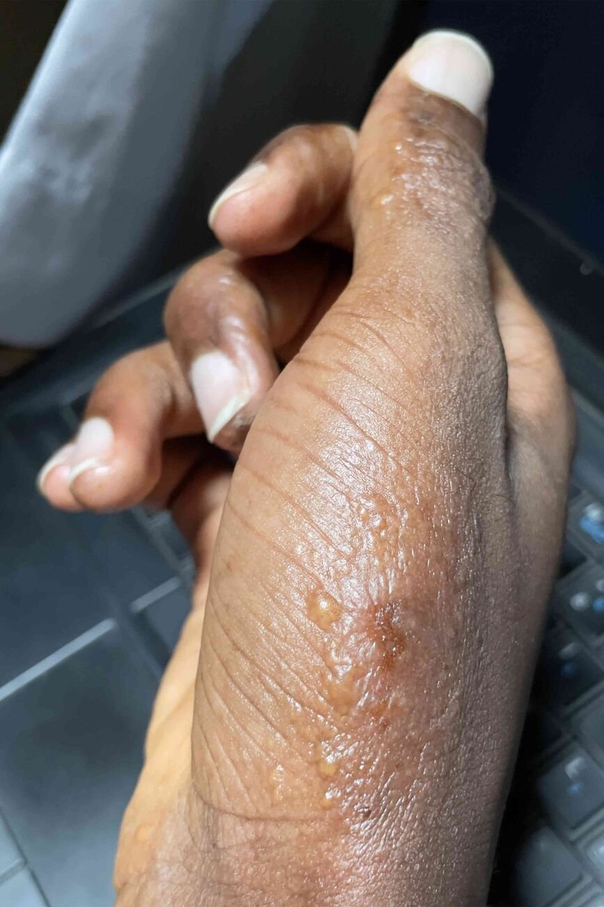 الجرب (Scabies)