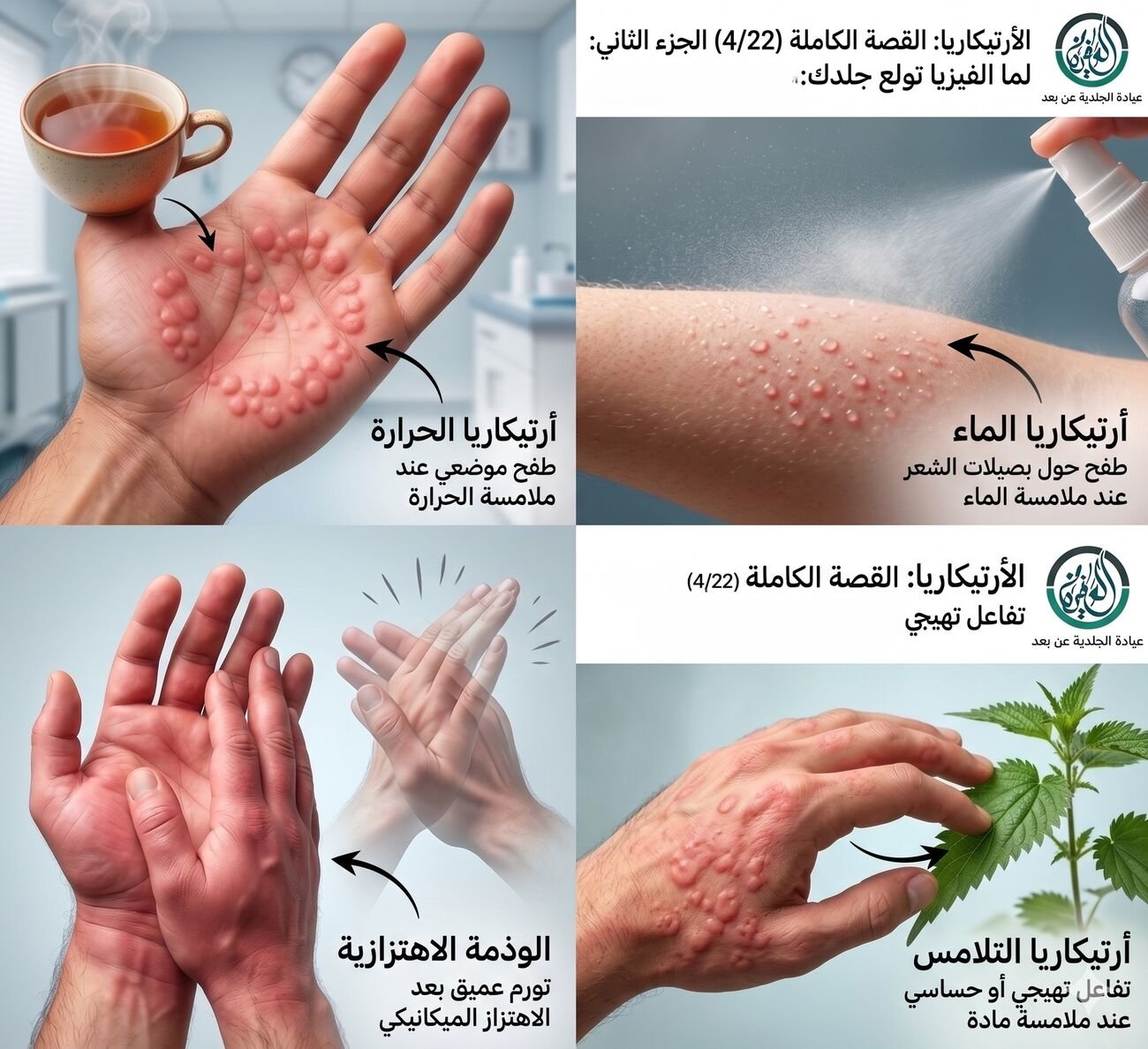 لما الفيزيا تولع جلدك: أرتيكاريا الضغط والشمس والاهتزاز والماء (الجزء الثاني)