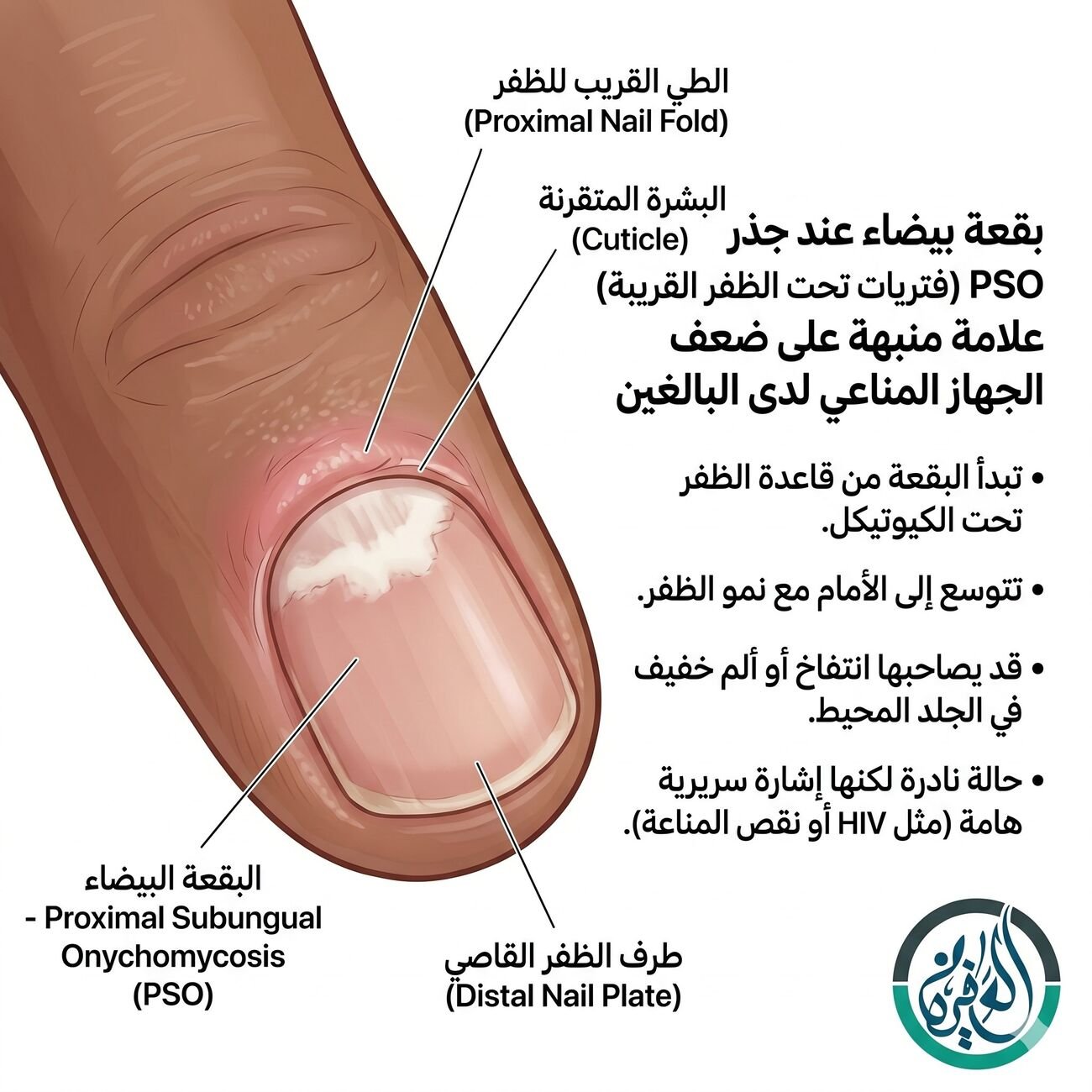 البقعة البيضاء عند جذر الظفر - النوع البنبه على ضعف المناعة