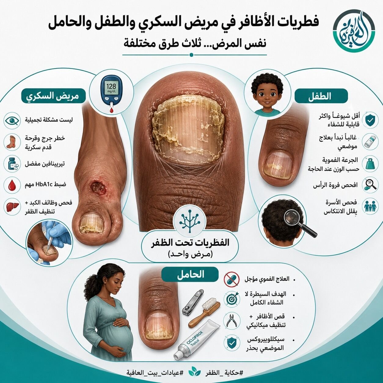 فطريات الأظافر في مريض السكري والطفل والحامل
