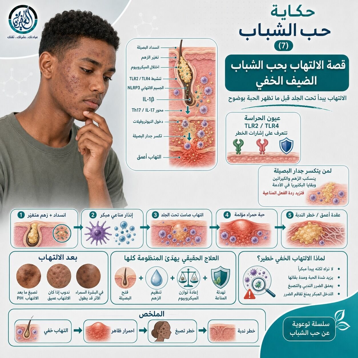قصة الالتهاب بحب الشباب – الضيف الخفي