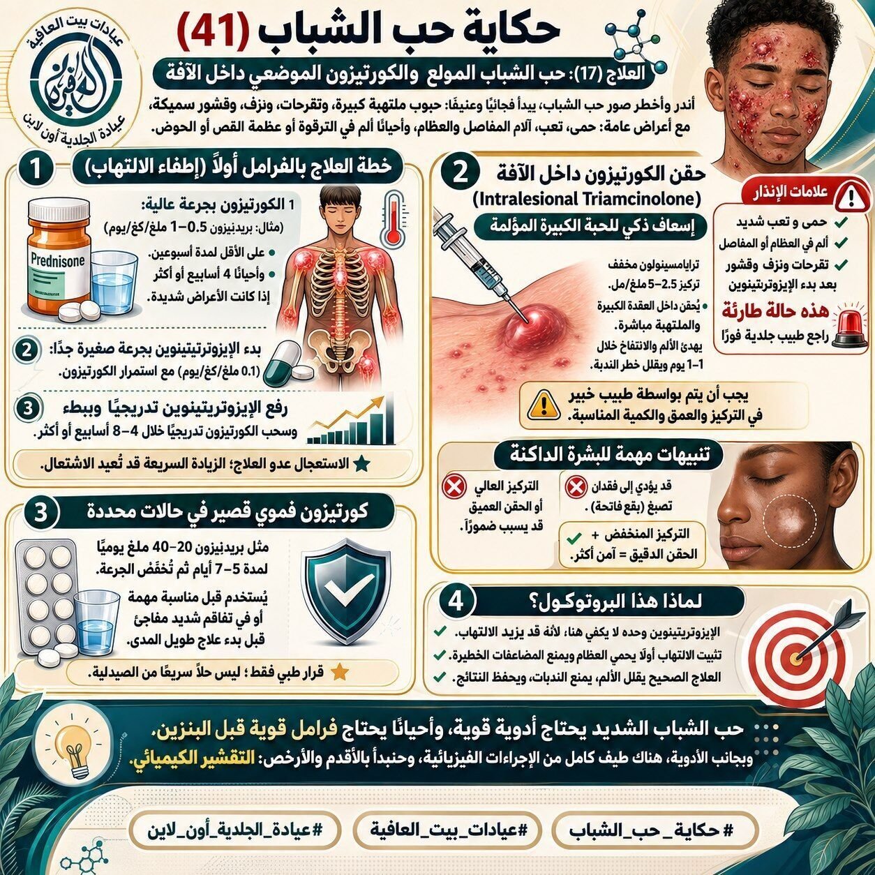 حب الشباب المولع  والكورتيزون الموضعي داخل الآفة