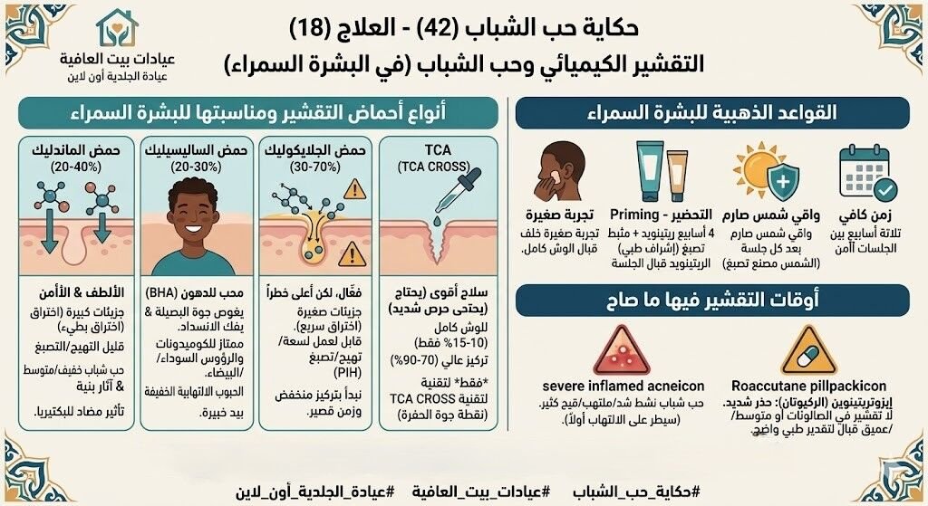 التقشير الكيميائي وحب الشباب
