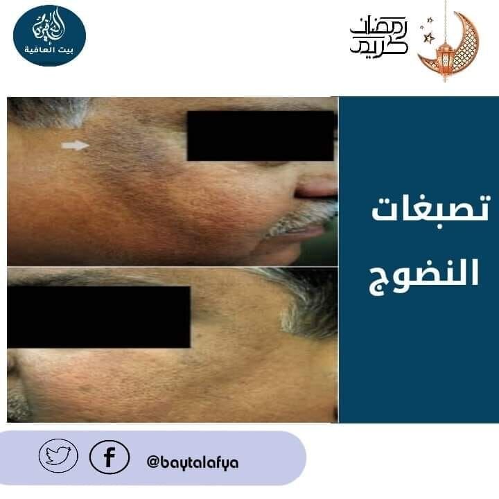 تصبغات النضوج Maturational Hyperpigmentation