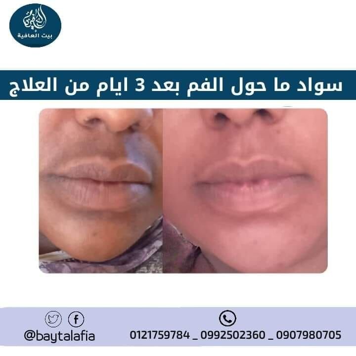 سواد ما حول الفم Perioral Hyperpigmentation