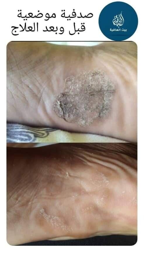 الصدفية الموضعية Localized Psoriasis