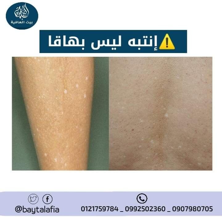 لا تقلق ليس بهاقا vitiligo